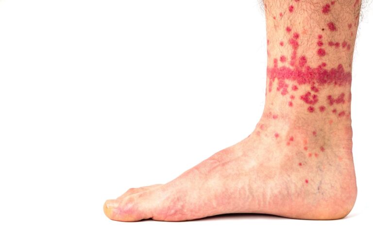 flea bites on a human ankle
